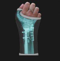 Xray Gets Printed Right onto Your Cast